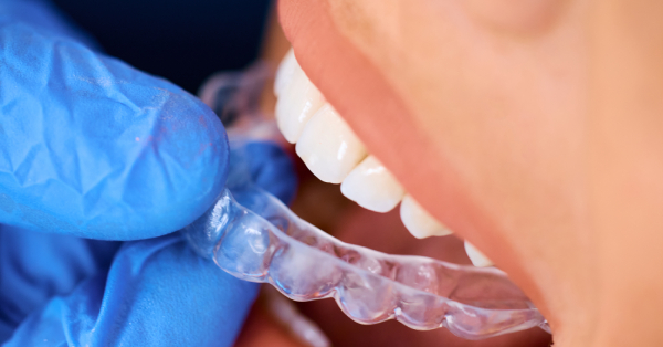 5 Expert Tips for Maintaining Your Invisalign in Garland 5 Expert Tips for Maintaining Your Invisalign in Garland