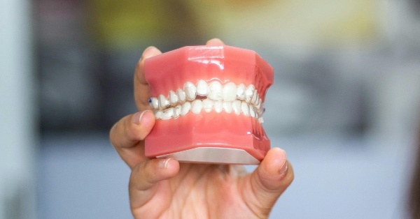 Are Dentures in Garland the Right Choice After Extractions?