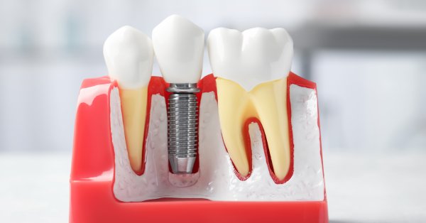 Helpful dental information about Dental Implants Garland TX