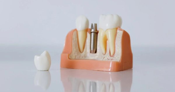 Emergency Dental Implants: Get the Best Care You Need