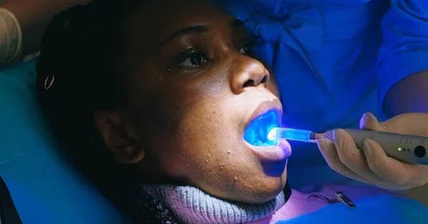 Teeth Whitening: Types, Process, & Side Effects | Garland