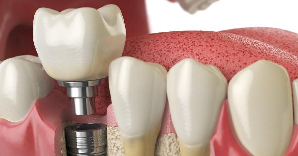 Top 5 Benefits of Dental Implants in Garland
