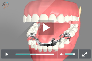 Partial Dentures Partial Dentures