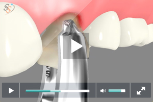 Routine Tooth Extraction Routine Tooth Extraction