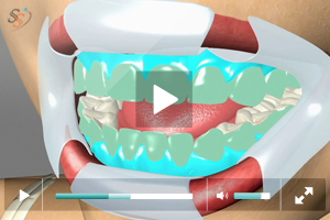 Teeth Whitening Teeth Whitening