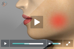 Why Third Molar Extraction Why Third Molar Extraction