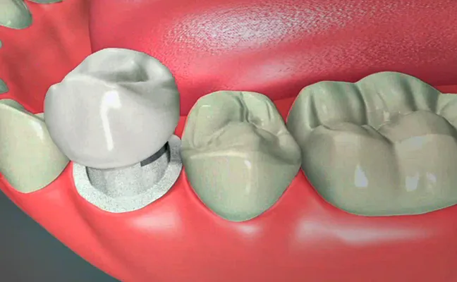 Crowns Crowns