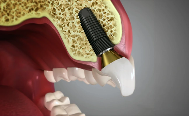 3D illustration of dental implant placement in Garland, TX jawbone.