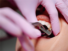 Extractions Extractions
