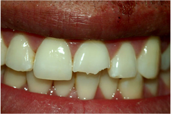 Dental Crowns and Bridges Before