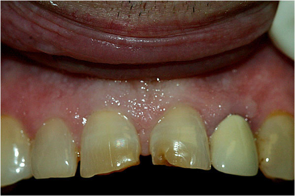 Dental Crowns and Bridges Before