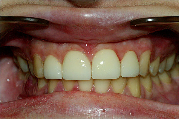 Dental Veneers After